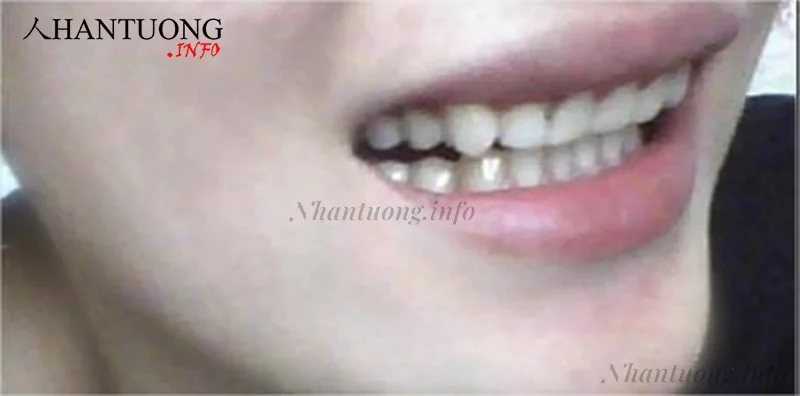 Hàm răng dưới hướng vào trong Hàm răng dưới hướng vào trong