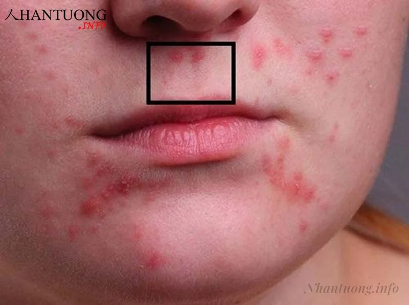 Mụn mọc ở nhân trung thường không tốt, cần tránh để lại sẹo Mụn mọc ở nhân trung thường không tốt, cần tránh để lại sẹo