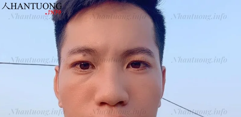 Nốt ruồi ở cung điền trạch của nam giới Nốt ruồi ở cung điền trạch của nam giới