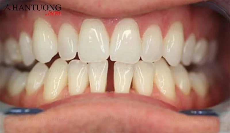 Tướng răng thưa khó giữa được tiền Tướng răng thưa khó giữa được tiền