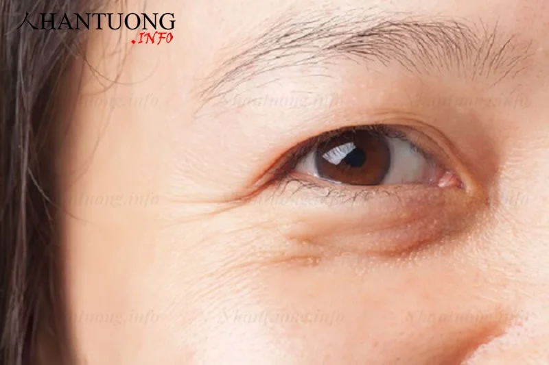 Hình ảnh nếp nhăn ở đuôi mắt Hình ảnh nếp nhăn ở đuôi mắt